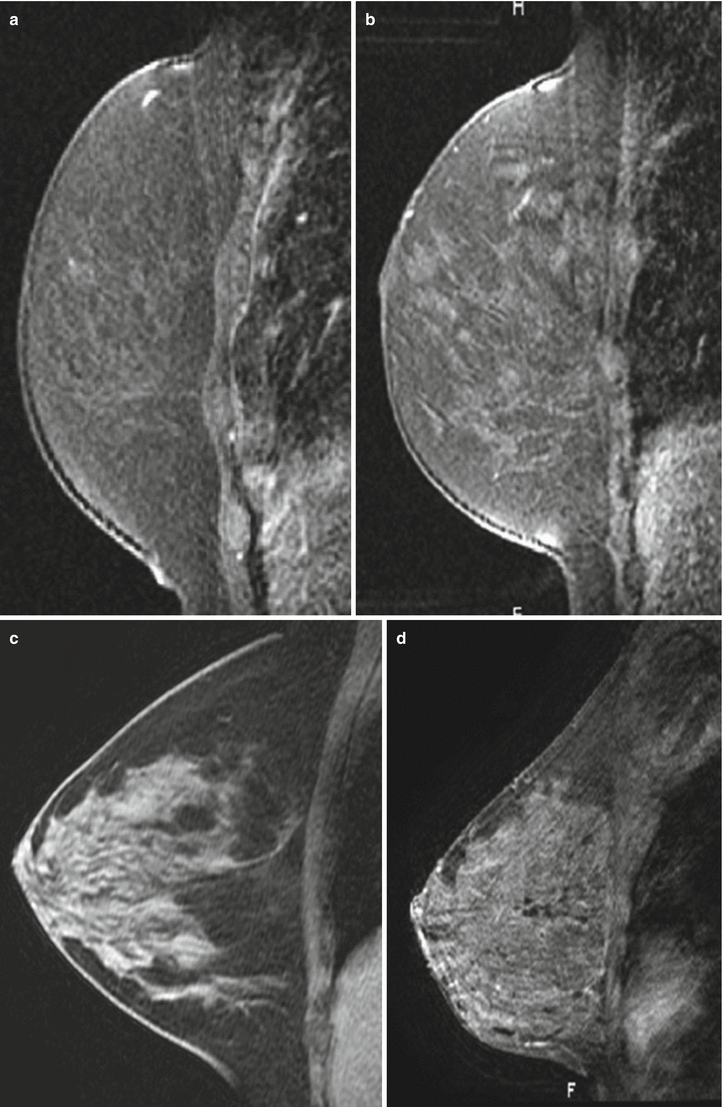 Fig 19 110 111 and 112 Selected sagittal T1 post-contrast image a - photo 9