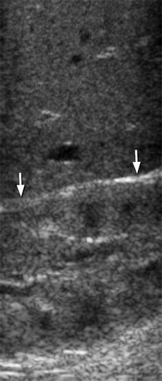 Fig 13 Ultrasound of the normal neonatal kidney in which the renal cortex is - photo 3