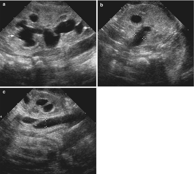 Fig 14 a Ultrasound of the kidney in the longitudinal plane demonstrates - photo 4