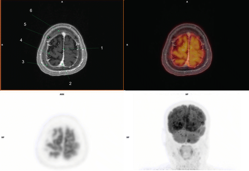 Fig 110 1 Falx cerebri2 Superior sagittal sinus3 Right parietal bone4 - photo 10