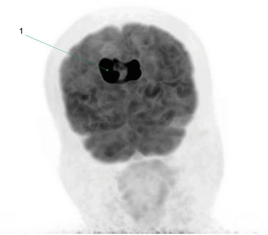 Fig 11 1 Primary central nervous system lymphoma Fig 12 1 Right - photo 1