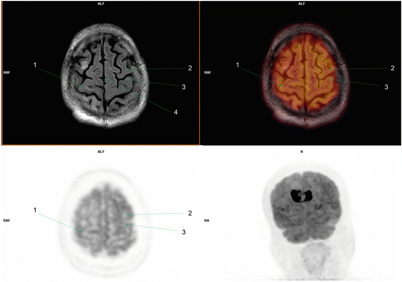 Fig 12 1 Right postcentral gyrus2 Left precentral gyrus3 Left - photo 2