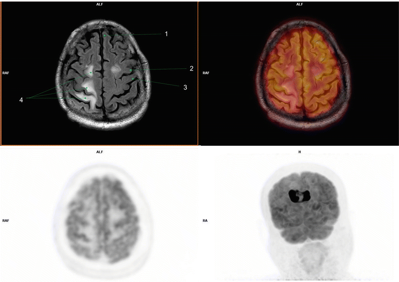 Fig 13 1 Left superior frontal gyrus2 Left precentral gyrus3 Left - photo 3