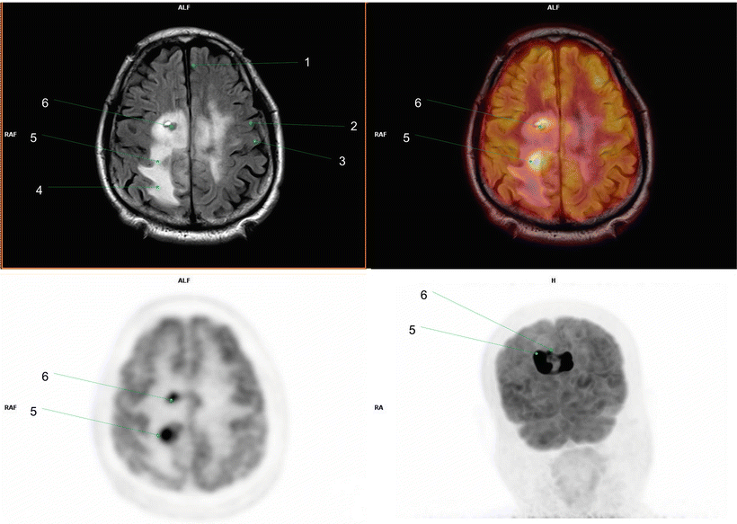 Fig 14 1 Left superior frontal gyrus2 Left precentral gyrus3 Left - photo 4