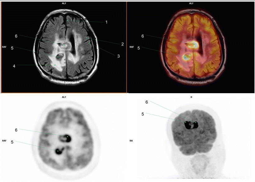 Fig 15 1 Left superior f rontal gyrus2 Left precentral gyrus3 Left - photo 5