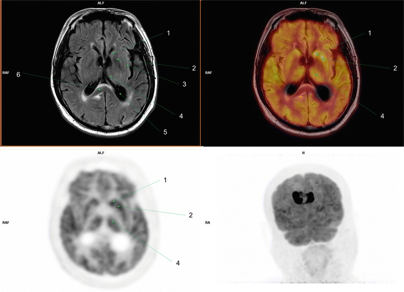 Fig 17 1 Left cauda te nucleus2 Left putamen3 Left insular cortex4 - photo 7