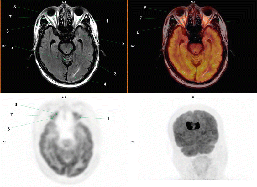 Fig 18 1 Left lat eral rectus muscle2 Left temporal cortex3 Midbrain4 - photo 8