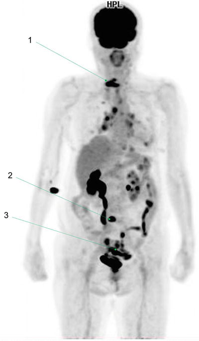 Fig 19 1 Bone metas tasis in cervical spine2 Bone metastasis in lumbar - photo 9