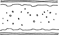 Villi flattened so particles of food cannot be absorbed and digested The - photo 3