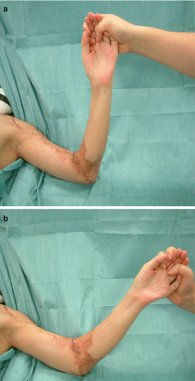 Fig 11 a b Procedure 1 Restriction in range of movement in the elbow - photo 3