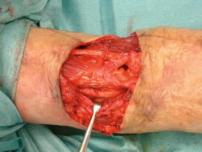 Fig 12 Procedure 2 After resecting the scar and conducting joint - photo 4