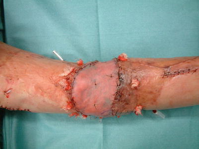 Fig 16 Procedure 6 A split-thickness skin graft is conducted on top of the - photo 8