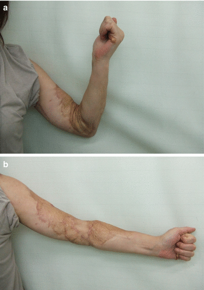 Fig 17 a b Procedure 7 After surgery the range of motion of the elbow - photo 9