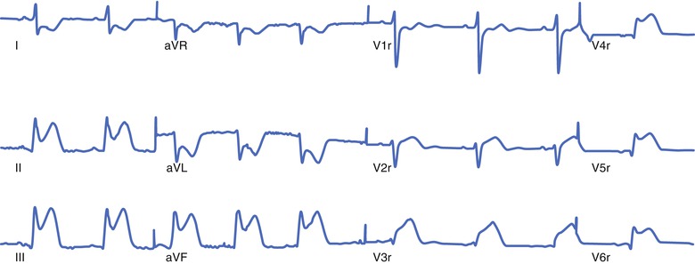 Posterior Infarction Cardiac Markers - photo 27