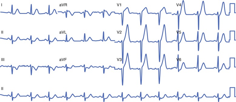 What Factors Predict MI on the EKG What Factors Predict Early - photo 17