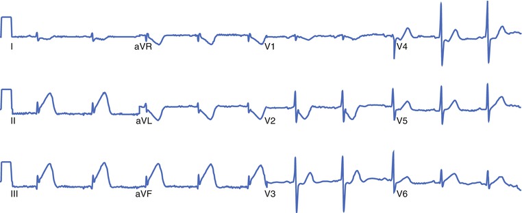 Inferior-Posterior MI Right Ventricular Infarction - photo 24