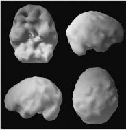 Image 14 ADD Before Treatment Decreased frontal lobe activity Image 15 - photo 10