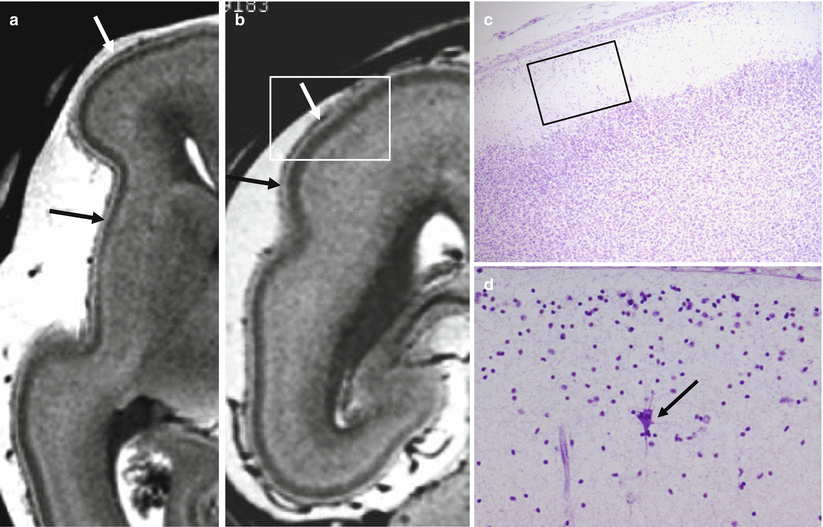 Fig 12 Marginal zone on fetal MR autopsy 22GW Layer I or marginal zone is - photo 2