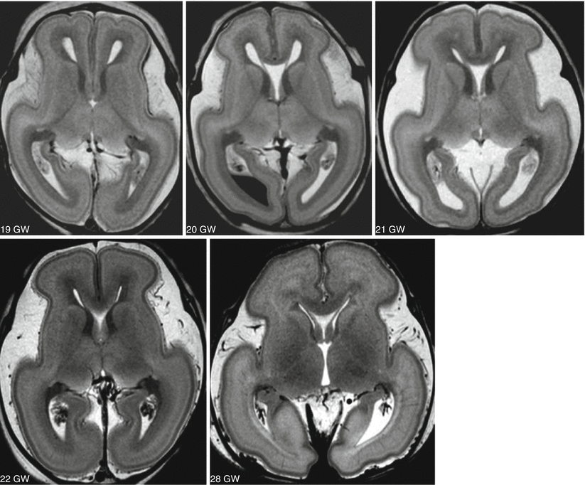 Fig 15 Fetal MR autopsy Normal cases at 19 20 21 22 and 28 GW - photo 5