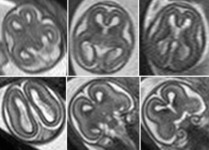 Fig 16 Fetal MR normal brain at 182 GW Fetal MR is usually not performed - photo 6