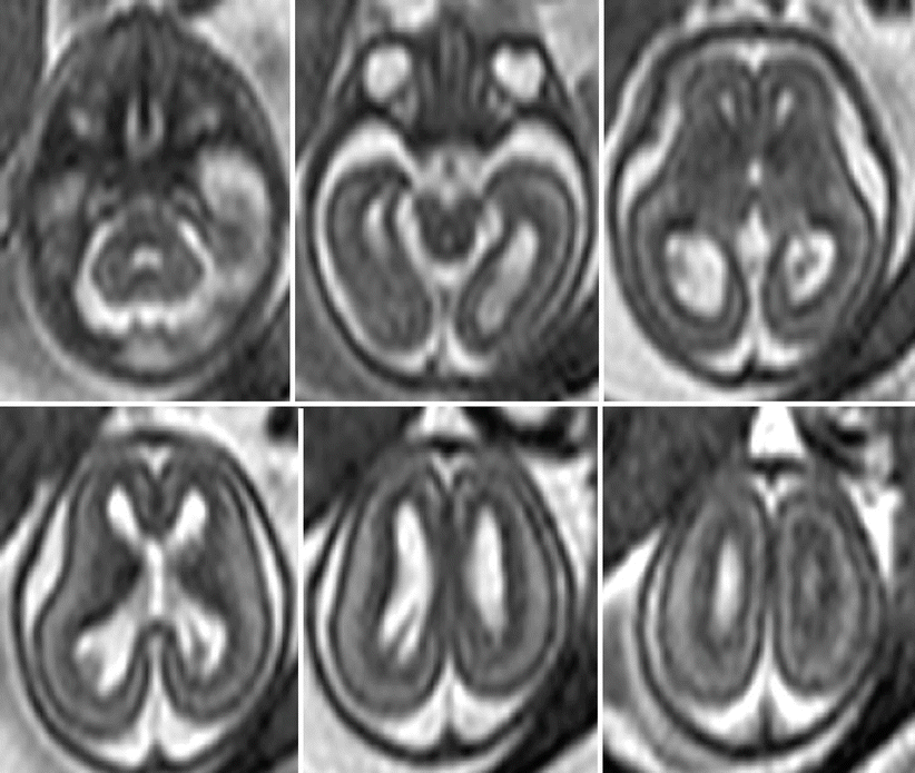 Fig 17 Fetal MR normal brain at 196 GW axial sections At this age the - photo 7