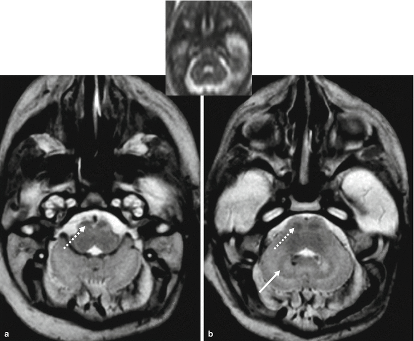 Perinatal neuroradiology from the fetus to the newborn - photo 8