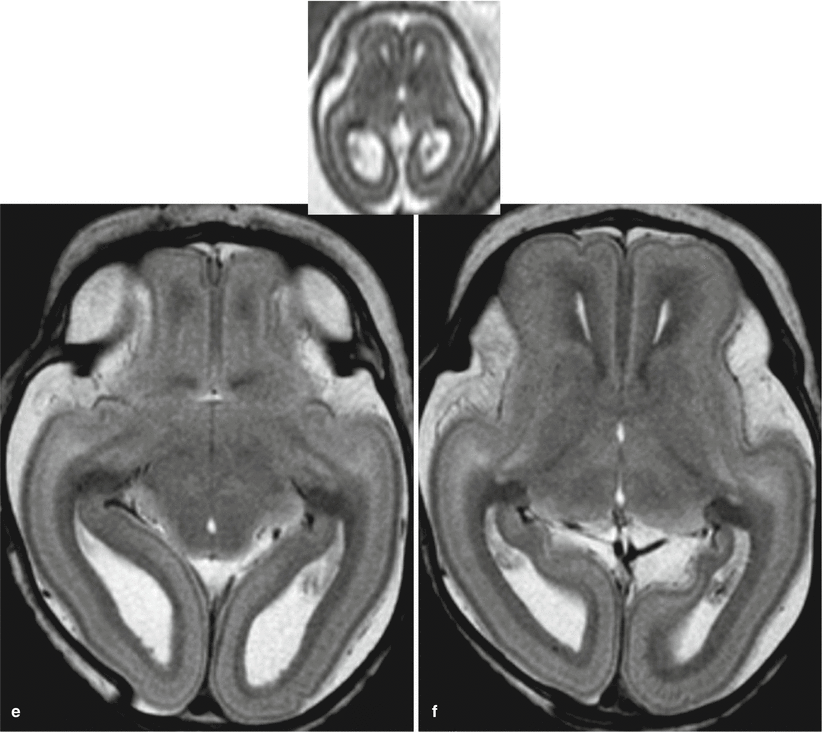 Fig 18 Fetal MR autopsy normal brain - photo 10