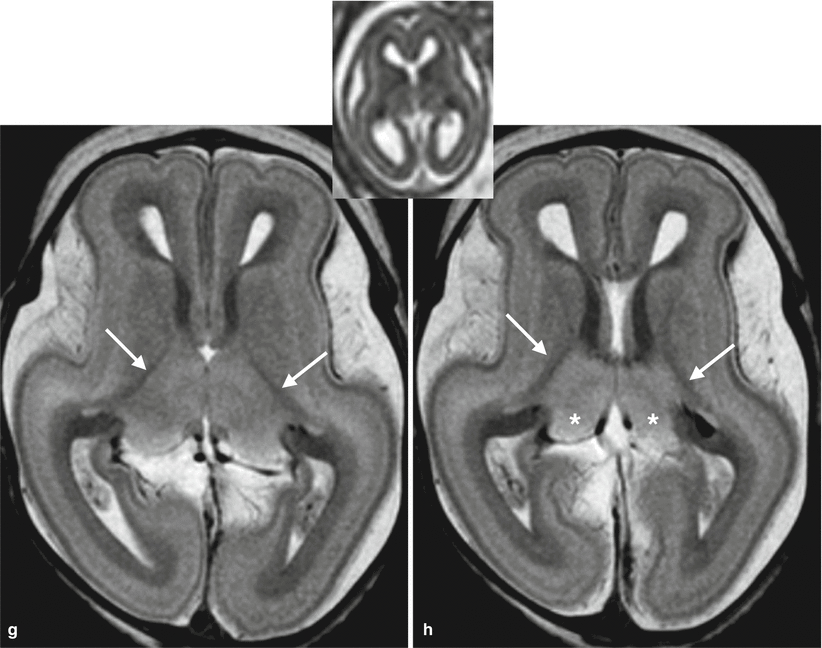 Fig 18 Fetal MR autopsy normal brain at 19 GW axial sections with - photo 11