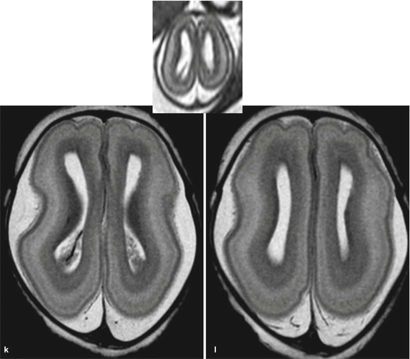 Fig 18 Fetal MR autopsy normal brain at 19 GW axial sections with - photo 13