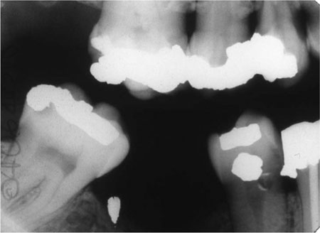 Fig 1-1 Bitewing radiograph showing a ledge on the amalgam restoration in the - photo 3