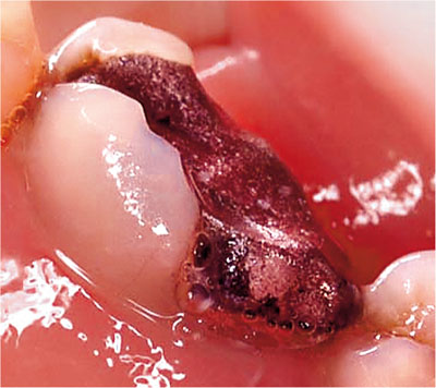 Fig 1-2 Given the extent of this cavity it is difficult to place an amalgam - photo 4