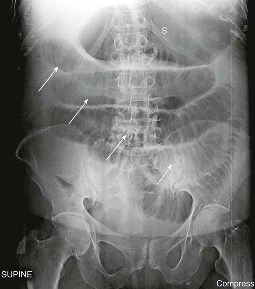 FIGURE 1-1 Small-bowel obstruction There are multiple air-filled and dilated - photo 2