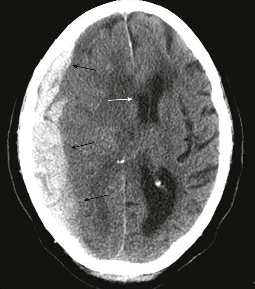 FIGURE 1-2 Subdural hematoma A curvilinear band of increased attenuation in - photo 3