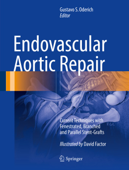 Factor David - Endovascular Aortic Repair