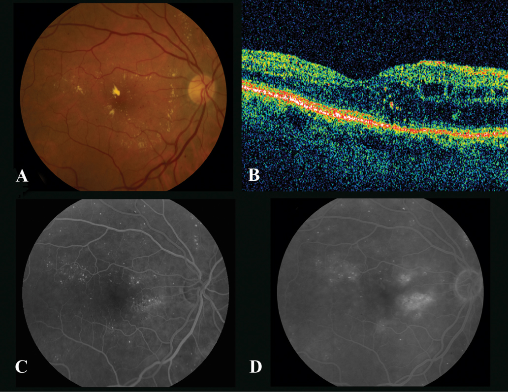 Fig 1 The right eye of a 55-year-old woman with mild macular edema A - photo 1