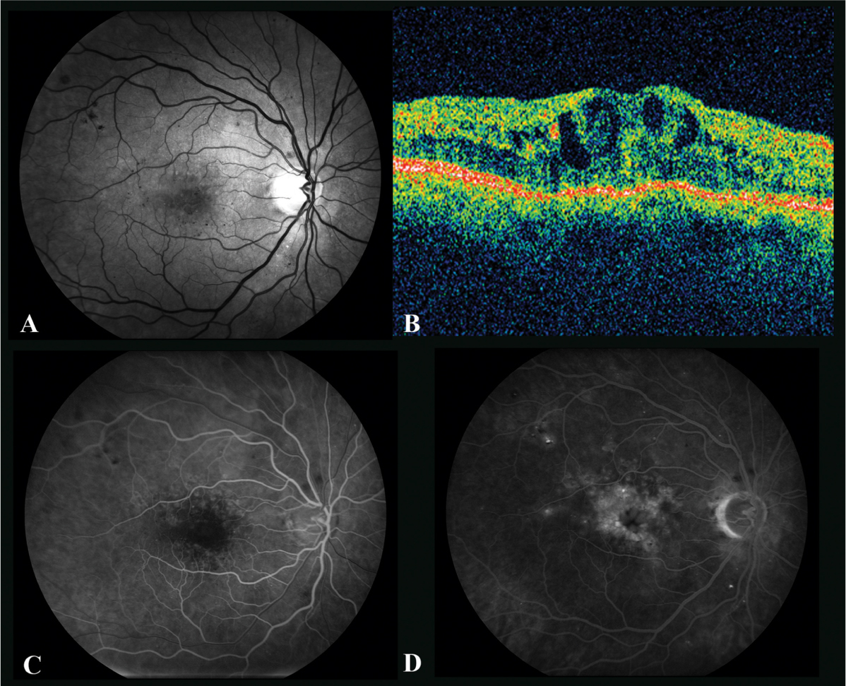 Fig 2 The right eye of a 68-year-old man with chronic macular edema A - photo 2