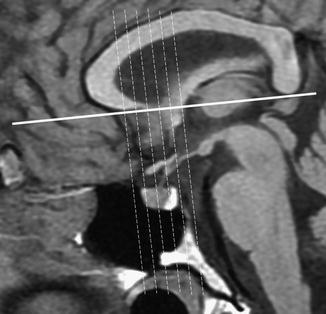 Fig 11 Sagittal T1WI The coronal cuts are obtained perpendicularly to the - photo 1