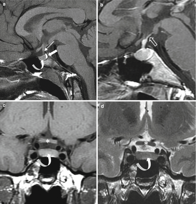 Fig 12 Normal pituitary gland a b Sagittal T1 and CE T1WIs c d - photo 2