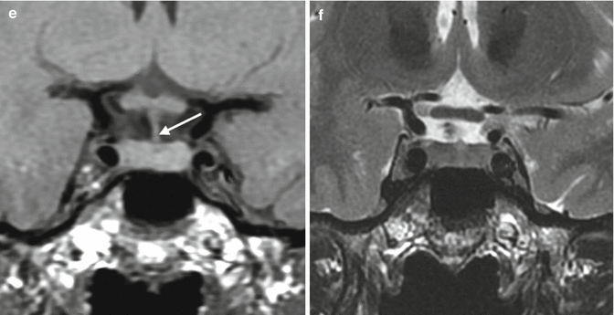 Fig 12 Normal pituitary gland a b Sagittal T1 and CE T1WIs c d - photo 3