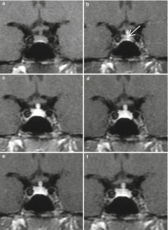 Fig 13 Dynamic MRI of the normal pituitary gland a Before contrast - photo 4