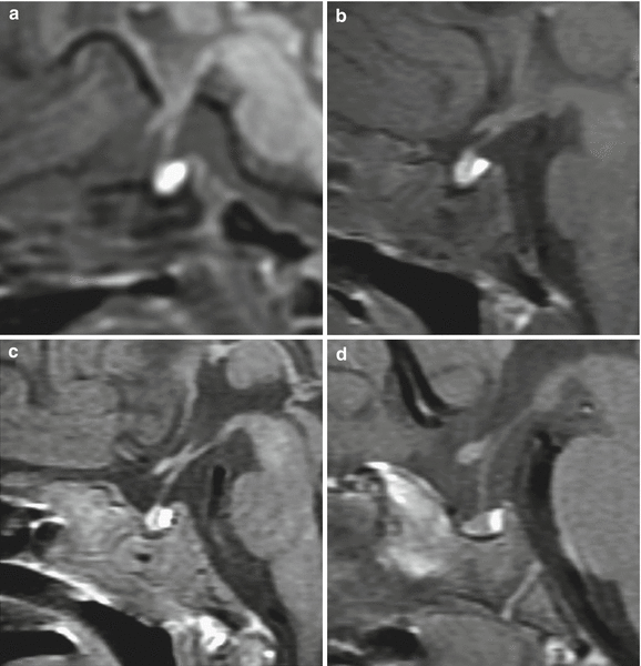 Fig 14 Pituitary gland in children sagittal T1WIs a 5-day-old newborn - photo 5