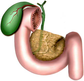 Fig 12 Agenesis of the dorsal pancreas Illustration shows the posterior - photo 2