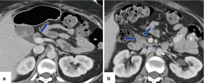 Fig 13 Agenesis of the dorsal pancreas on computed tomography CT a b - photo 3