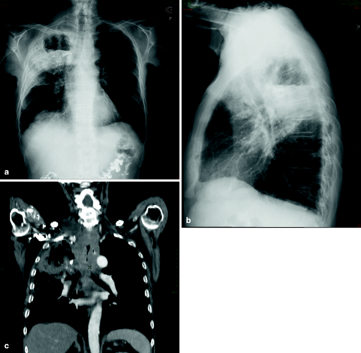 Fig 12 Images obtained from a 76-year-old man with previous oropharyngeal - photo 2