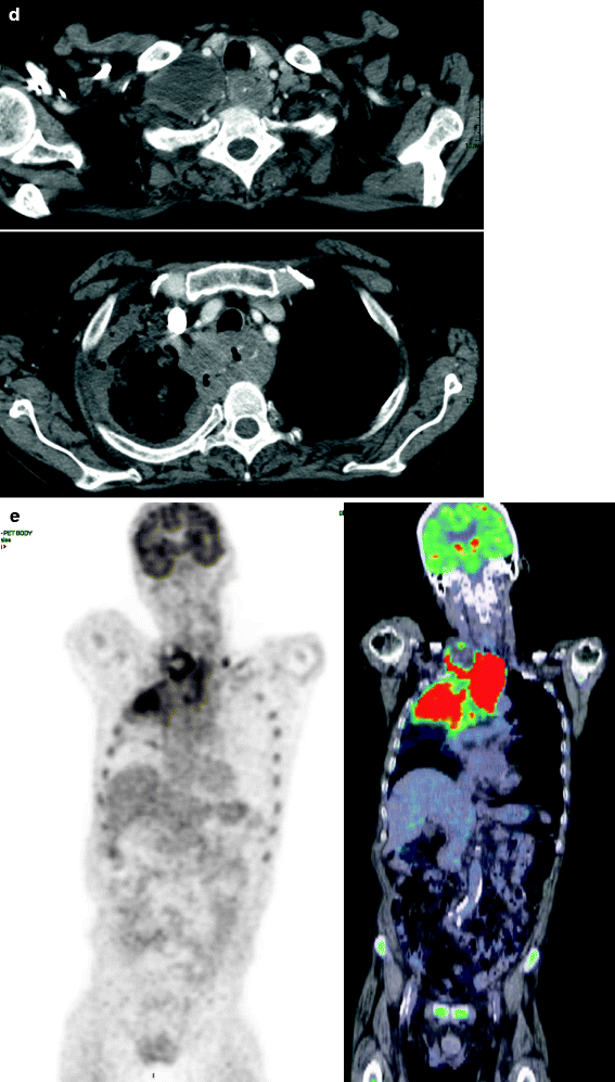 Fig 12 Images obtained from a 76-year-old man with previous oropharyngeal - photo 3