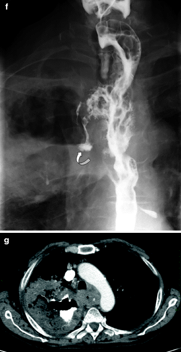 Fig 12 Images obtained from a 76-year-old man with previous oropharyngeal - photo 4