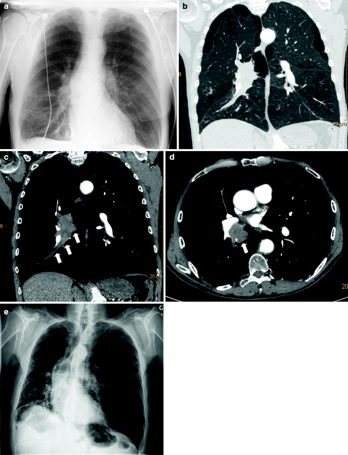 Fig 13 Images obtained from a 75-year-old man with chronic obstructive - photo 5