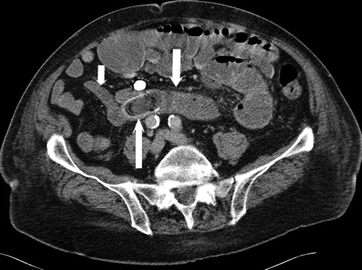 Image 6 Gallstone ileus is a rare complication of gallstone disease - photo 6