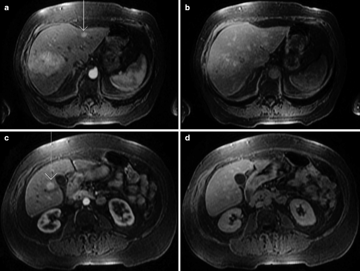 Image 7 Dynamic post-gadolinium fat sat T1 scans Images 7ad were performed - photo 13