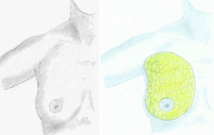 Fig 11 The breast overlies the anterolateral chest wall containing primarily - photo 1